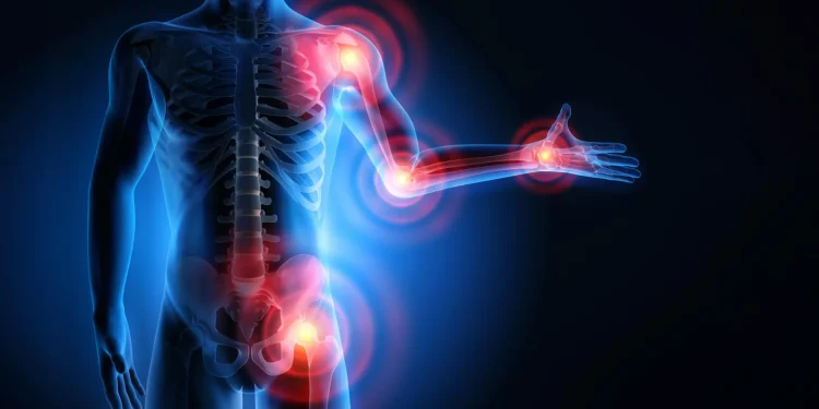 Una scoperta apre la strada a statine senza dolori muscolari